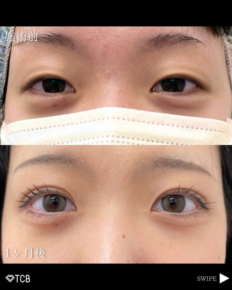 二重埋没法(担当医:古市 吉真 医師)の症例写真3