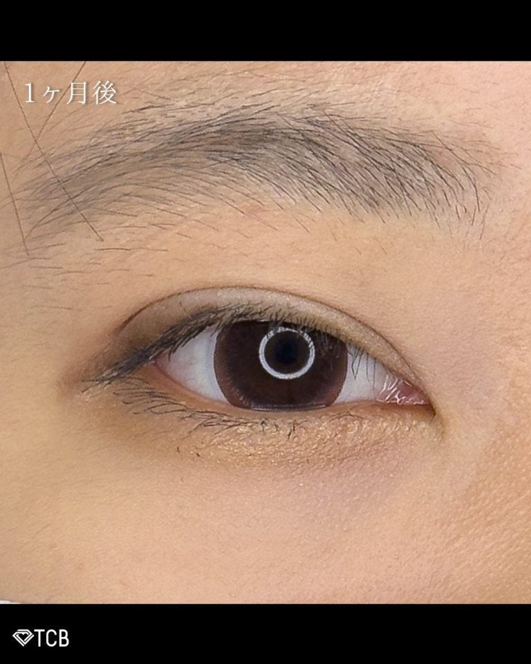 二重埋没法(担当医:古市 吉真 医師)の症例写真3