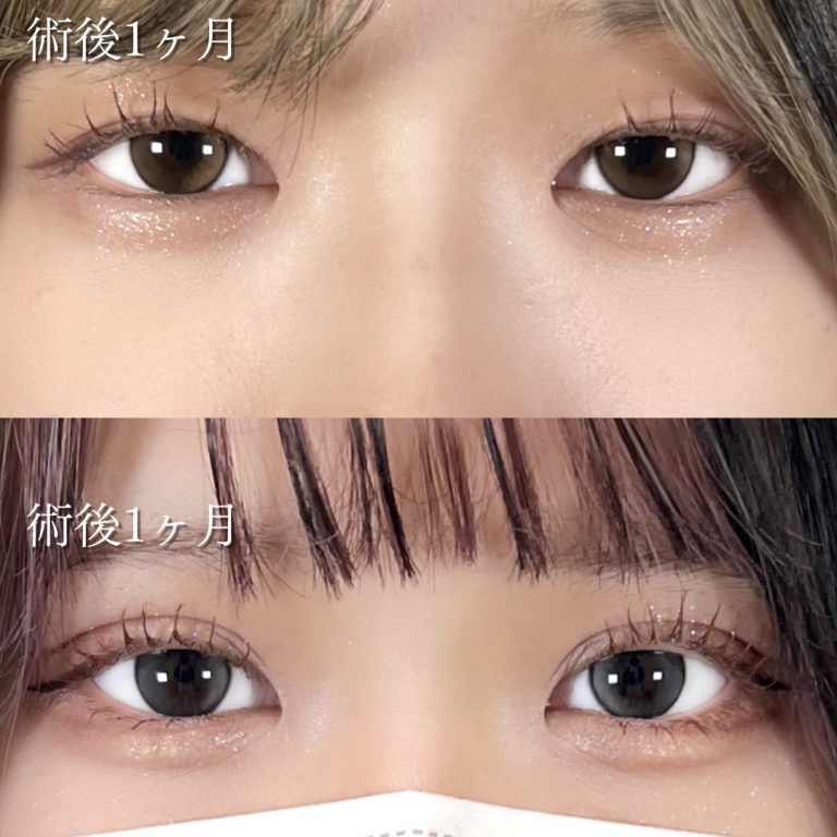 二重埋没法(担当医:川島 康弘 医師)の症例写真4