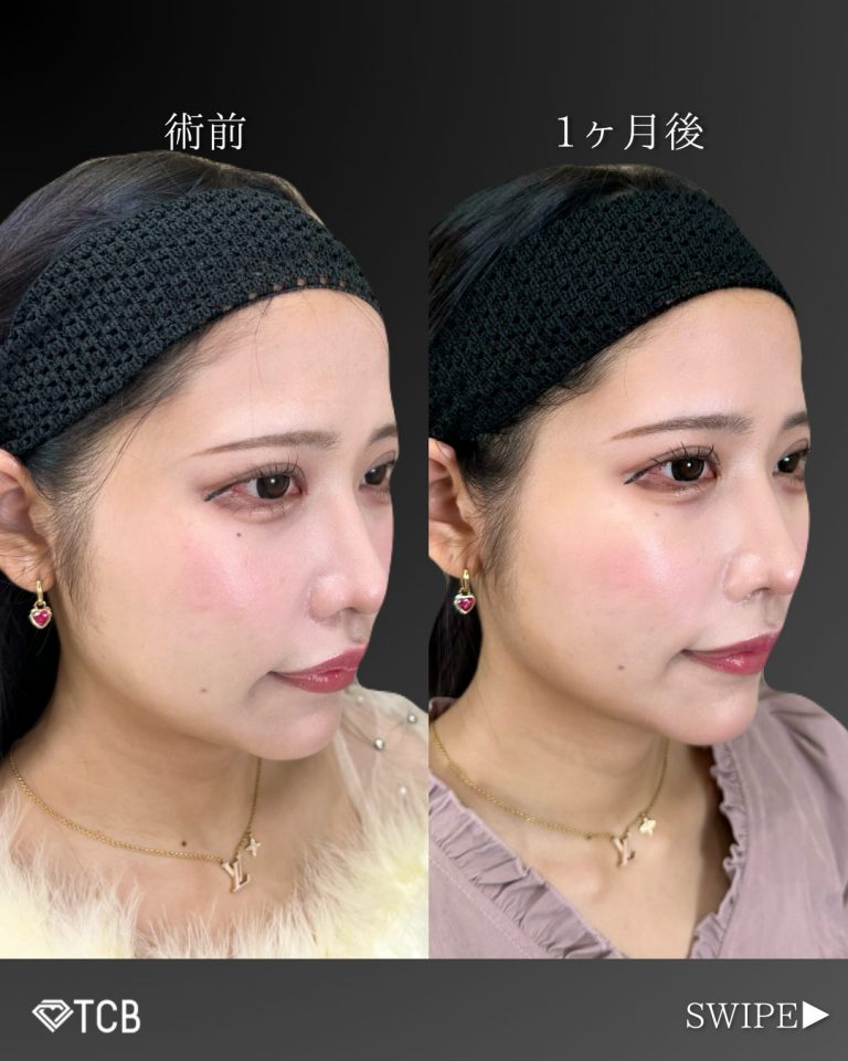 小顔美肌再生（リフトアップ）(担当医:古市 吉真 医師)の症例写真2