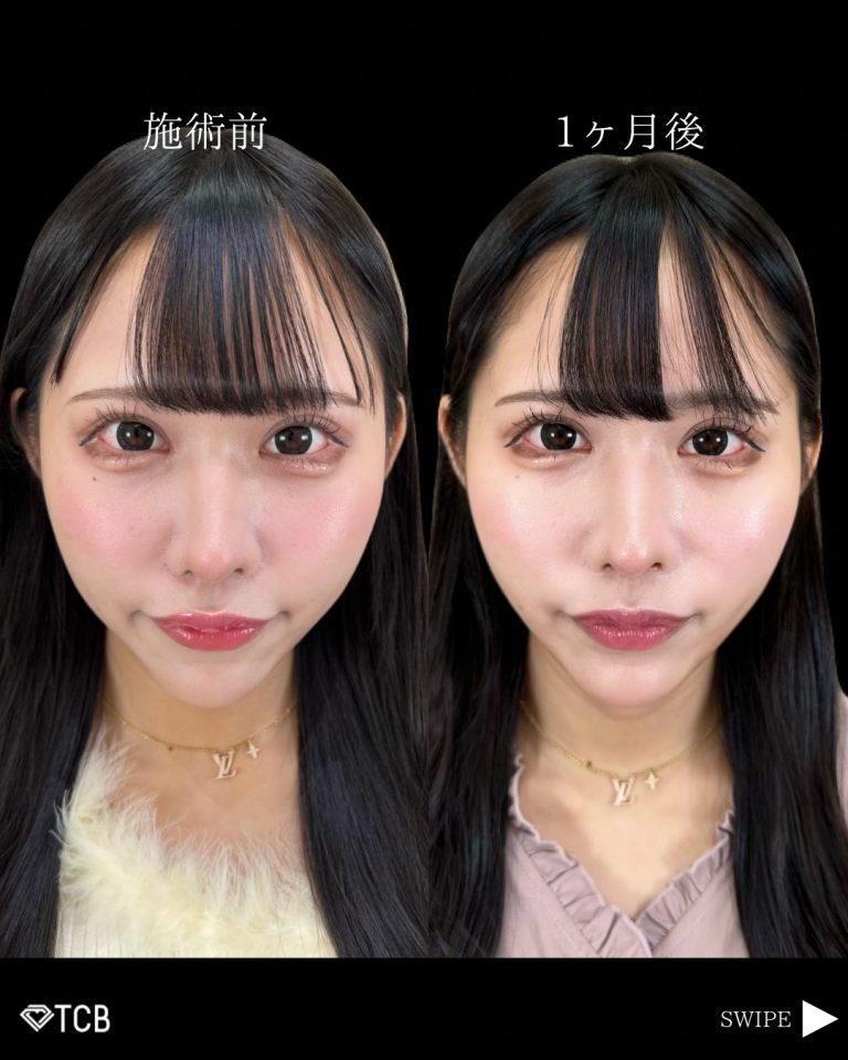 小顔美肌再生（リフトアップ）(担当医:古市 吉真 医師)の症例写真3