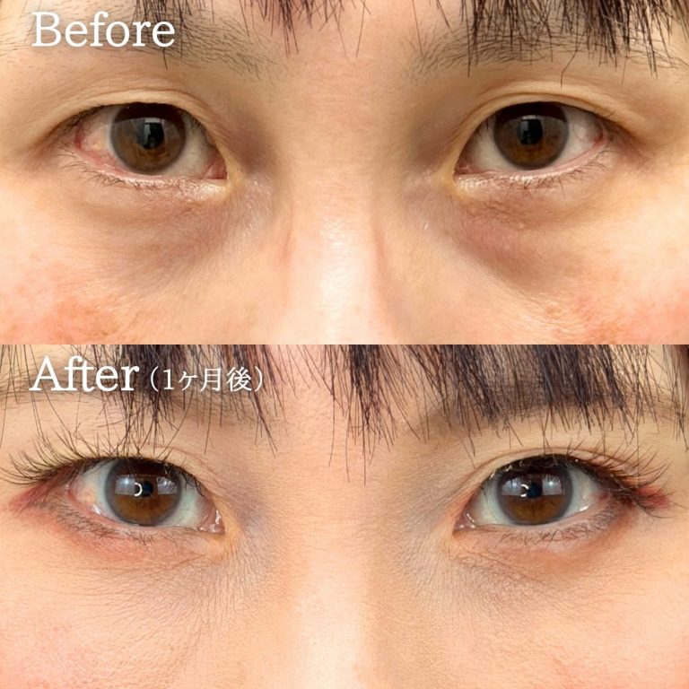 切らない目の下のクマ取り・目の下のたるみ（ふくらみ）取り(担当医:丁 強 医師)の症例写真1
