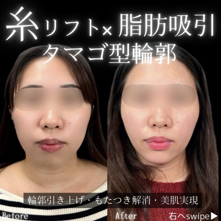 ジョールファット除去(担当医:川島 康弘 医師)の症例写真2