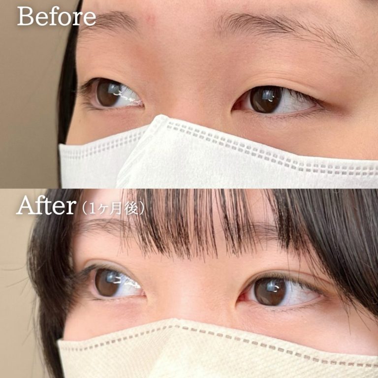 二重埋没法(担当医:丁 強 医師)の症例写真2