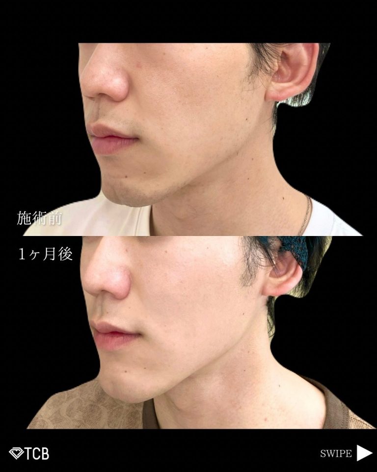 小顔美肌再生（リフトアップ）(担当医:古市 吉真 医師)の症例写真3