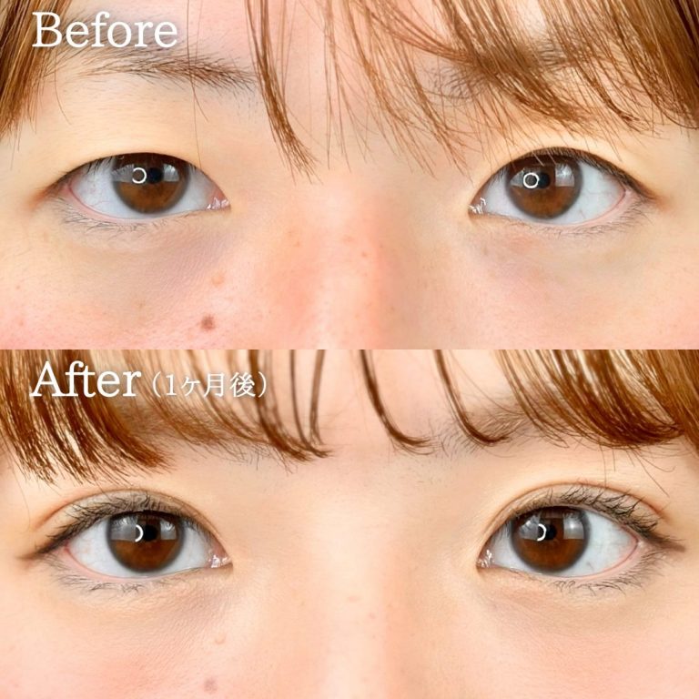 二重埋没法(担当医:丁 強 医師)の症例写真1
