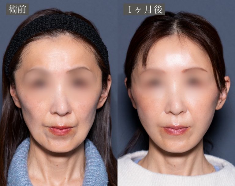 小顔美肌再生（リフトアップ）(担当医:岡本 卓也 医師)の症例写真1