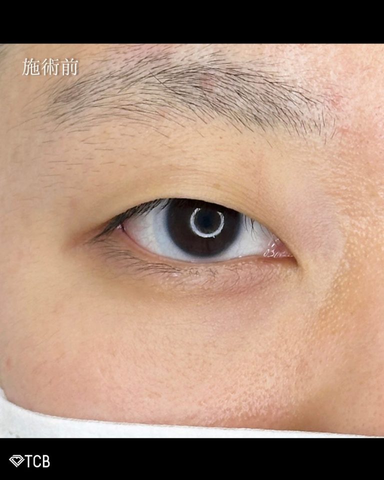 二重埋没法(担当医:古市 吉真 医師)の症例写真2
