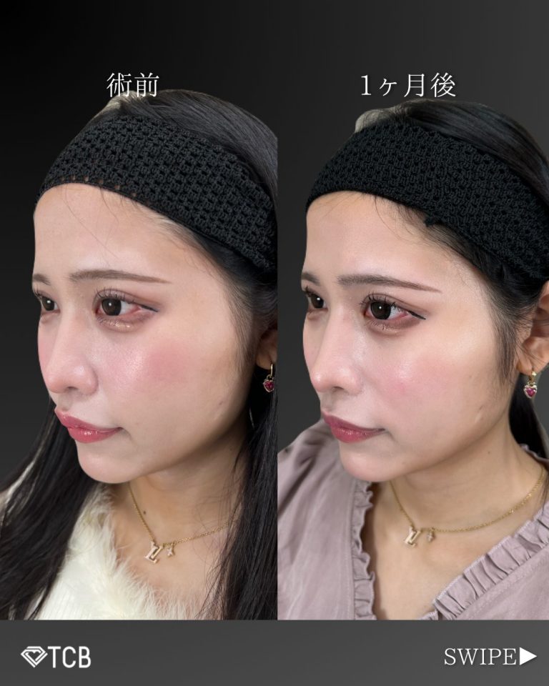 小顔美肌再生（リフトアップ）(担当医:古市 吉真 医師)の症例写真1