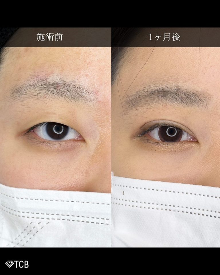 二重埋没法(担当医:古市 吉真 医師)の症例写真1