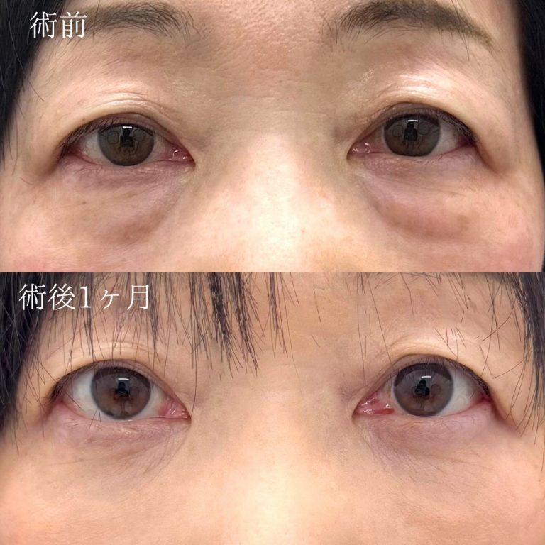 切らない目の下のクマ取り・目の下のたるみ（ふくらみ）取り(担当医:奥田 真吾 医師)の症例写真1