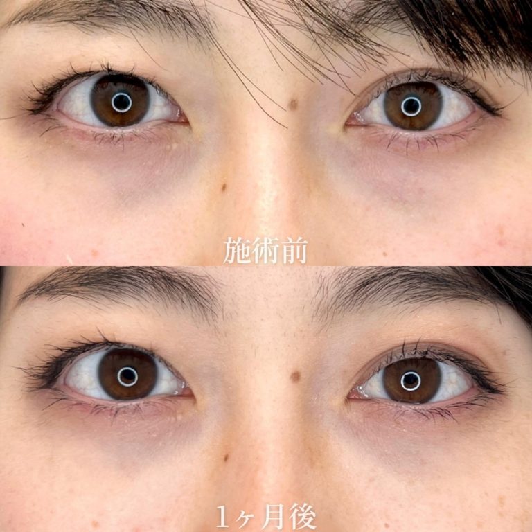 切らない目の下のクマ取り・目の下のたるみ（ふくらみ）取り(担当医:垣花 瑠美子 医師)の症例写真1