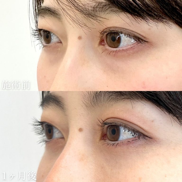 切らない目の下のクマ取り・目の下のたるみ（ふくらみ）取り(担当医:垣花 瑠美子 医師)の症例写真2