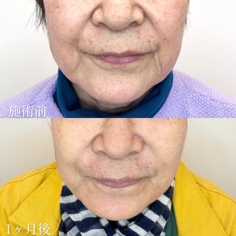 TCB小顔リフト(担当医:垣花 瑠美子 医師)の症例写真1