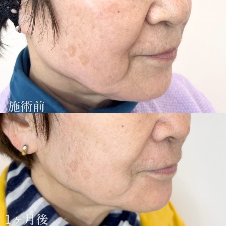 TCB小顔リフト(担当医:垣花 瑠美子 医師)の症例写真2