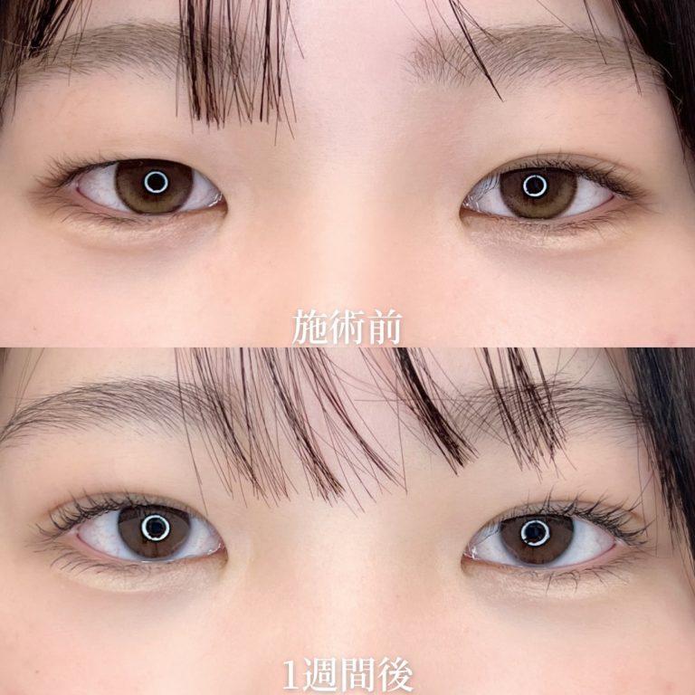 二重埋没法(担当医:垣花 瑠美子 医師)の症例写真1