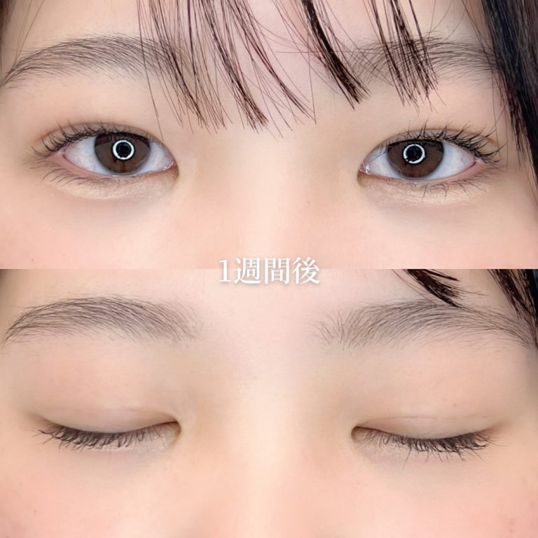 二重埋没法(担当医:垣花 瑠美子 医師)の症例写真2