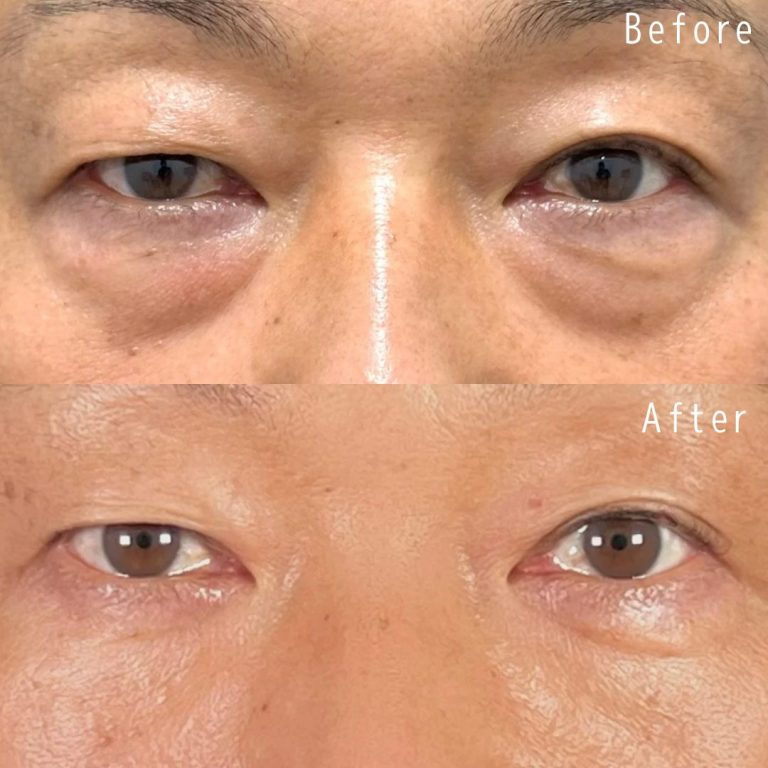 切らない目の下のクマ取り・目の下のたるみ（ふくらみ）取り(担当医:佐野 孝治 医師)の症例写真1