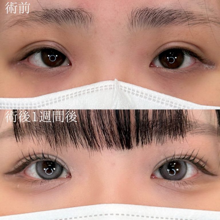 二重埋没法(担当医:三好 翔輝 医師)の症例写真1