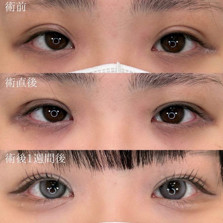 二重埋没法(担当医:三好 翔輝 医師)の症例写真2