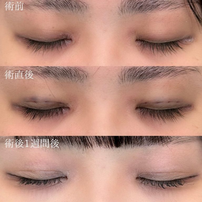 二重埋没法(担当医:三好 翔輝 医師)の症例写真3