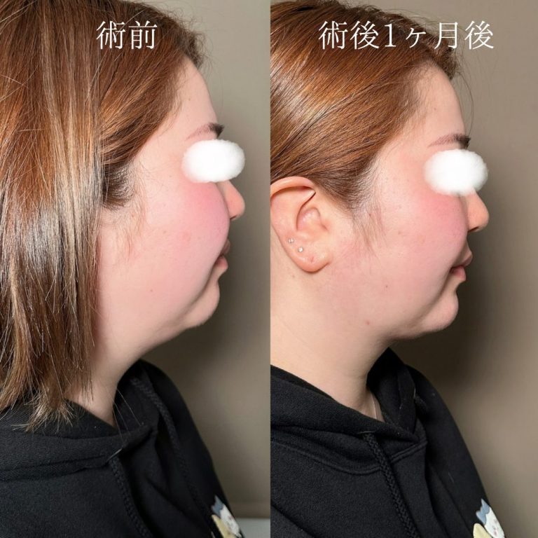 顔の脂肪吸引(担当医:三好 翔輝 医師)の症例写真1