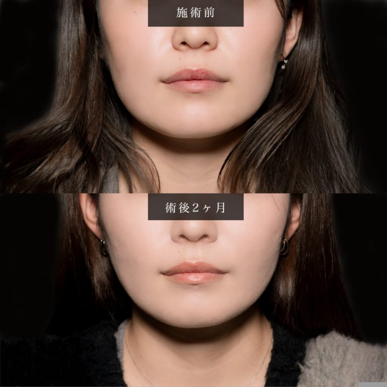 小顔美肌再生（リフトアップ）(担当医:北村 可恋 医師)の症例写真1