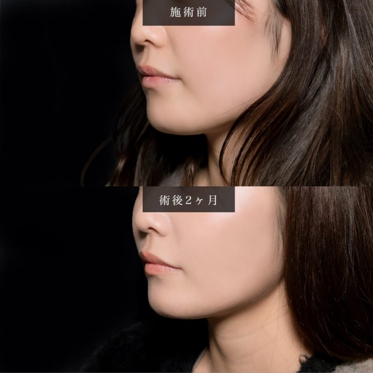小顔美肌再生（リフトアップ）(担当医:北村 可恋 医師)の症例写真2