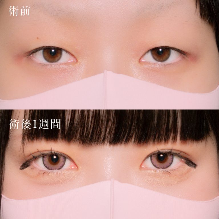 二重埋没法(担当医:北村 可恋 医師)の症例写真1