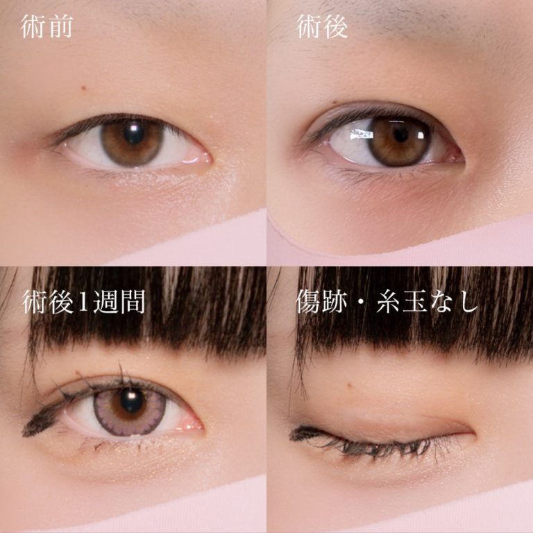 二重埋没法(担当医:北村 可恋 医師)の症例写真2
