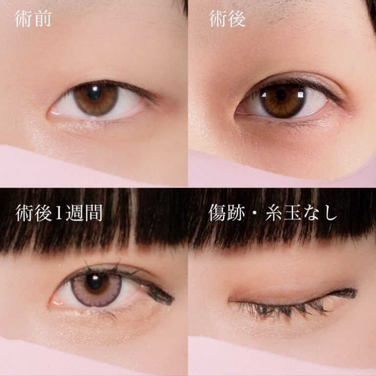 二重埋没法(担当医:北村 可恋 医師)の症例写真3