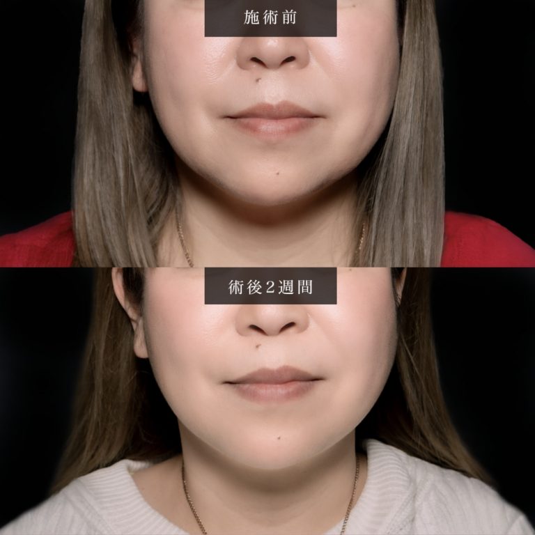 小顔美肌再生（リフトアップ）(担当医:北村 可恋 医師)の症例写真1