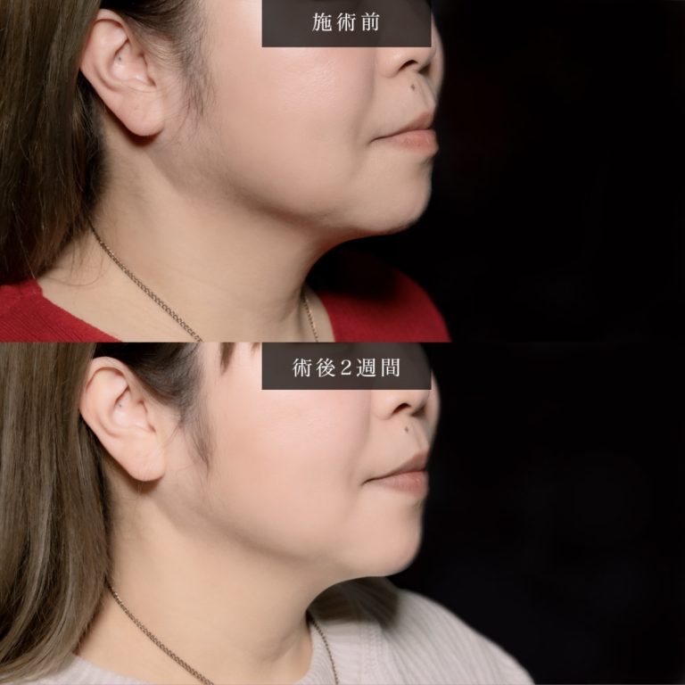 小顔美肌再生（リフトアップ）(担当医:北村 可恋 医師)の症例写真2