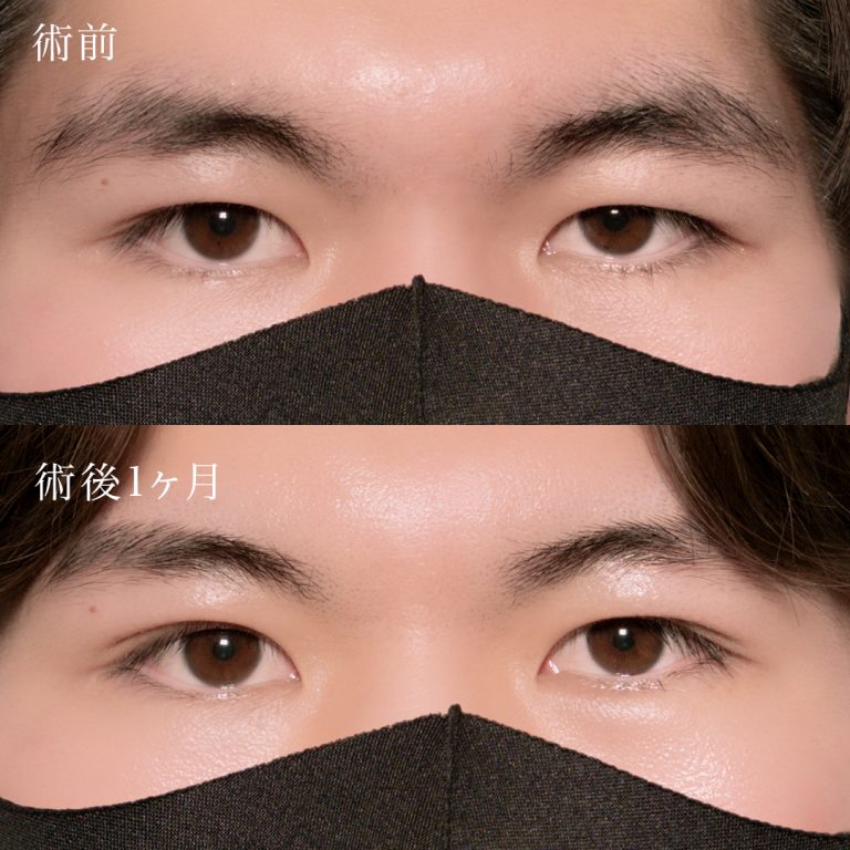二重埋没法(担当医:北村 可恋 医師)の症例写真1