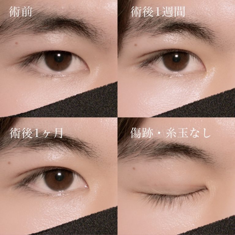 二重埋没法(担当医:北村 可恋 医師)の症例写真2