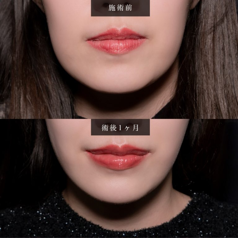 顔の脂肪吸引(担当医:北村 可恋 医師)の症例写真1