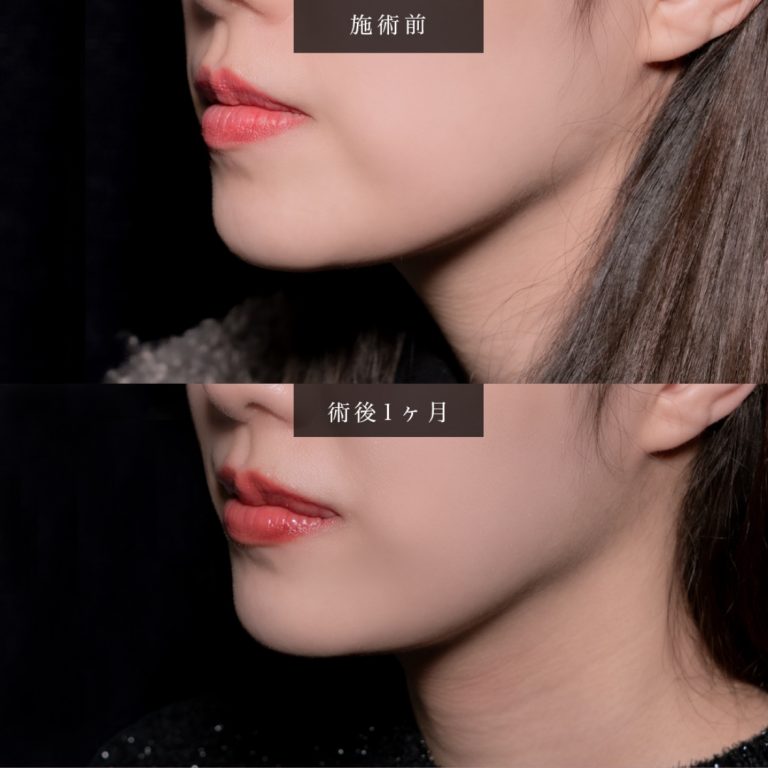 顔の脂肪吸引(担当医:北村 可恋 医師)の症例写真2