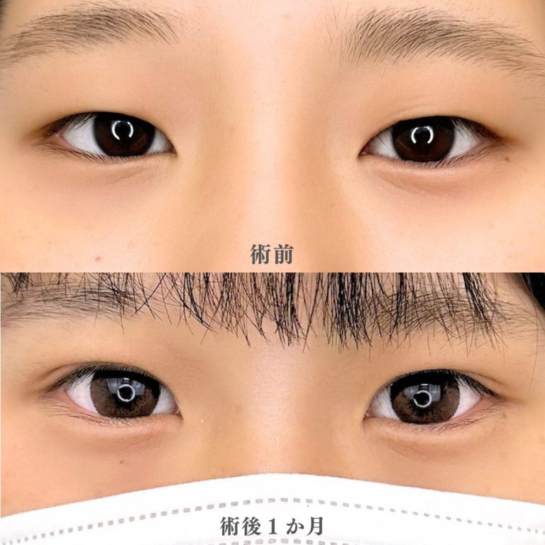 二重埋没法(担当医:石原 翼 医師)の症例写真1
