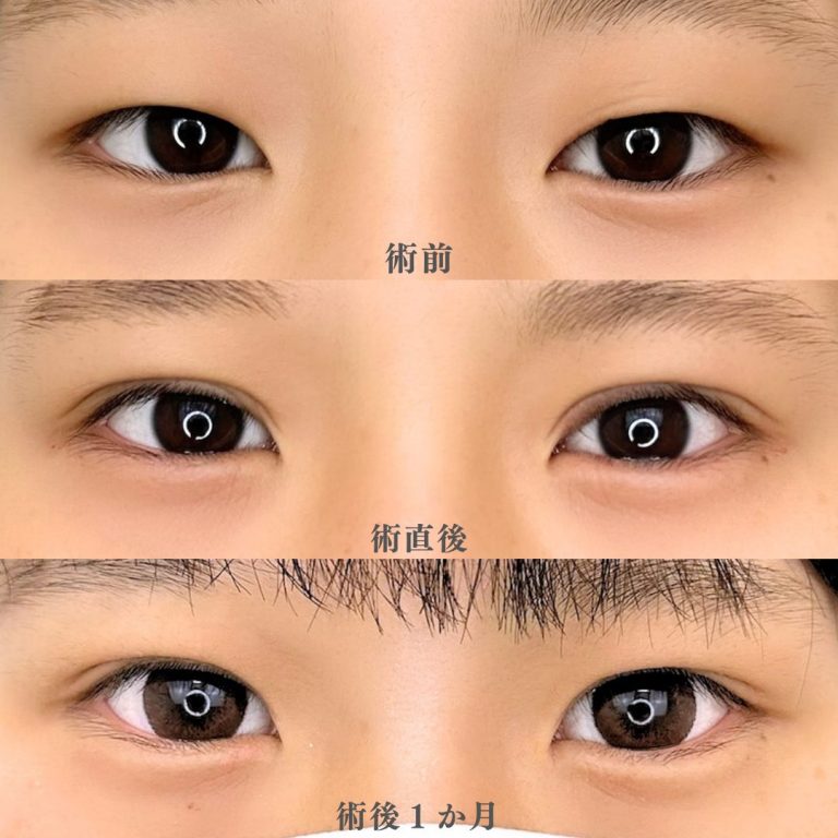 二重埋没法(担当医:石原 翼 医師)の症例写真2