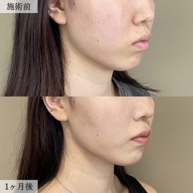 バッカルファット除去(担当医:大見 貴秀 医師)の症例写真2