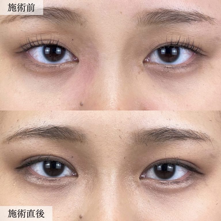 二重埋没法(担当医:大見 貴秀 医師)の症例写真1