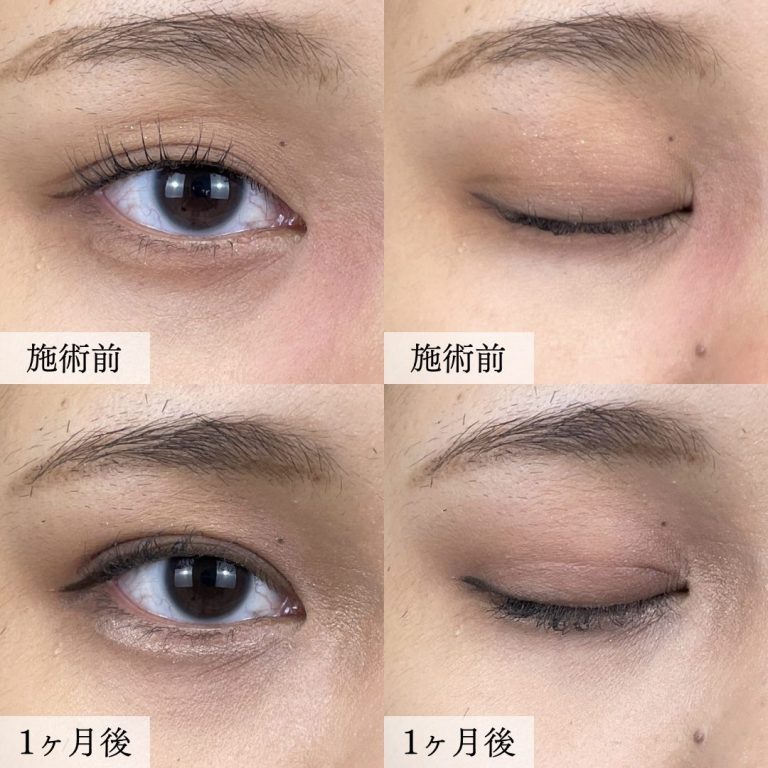 二重埋没法(担当医:大見 貴秀 医師)の症例写真2