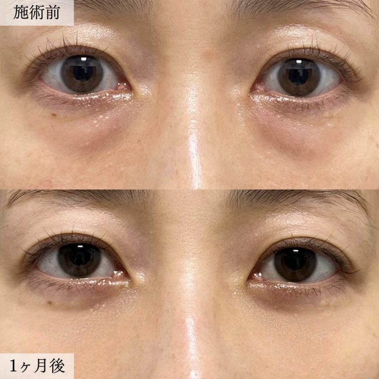 切らない目の下のクマ取り・目の下のたるみ（ふくらみ）取り(担当医:大見 貴秀 医師)の症例写真1