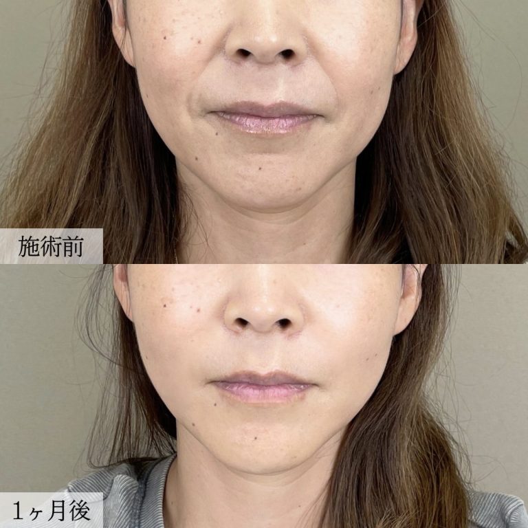 小顔美肌再生（リフトアップ）(担当医:大見 貴秀 医師)の症例写真1