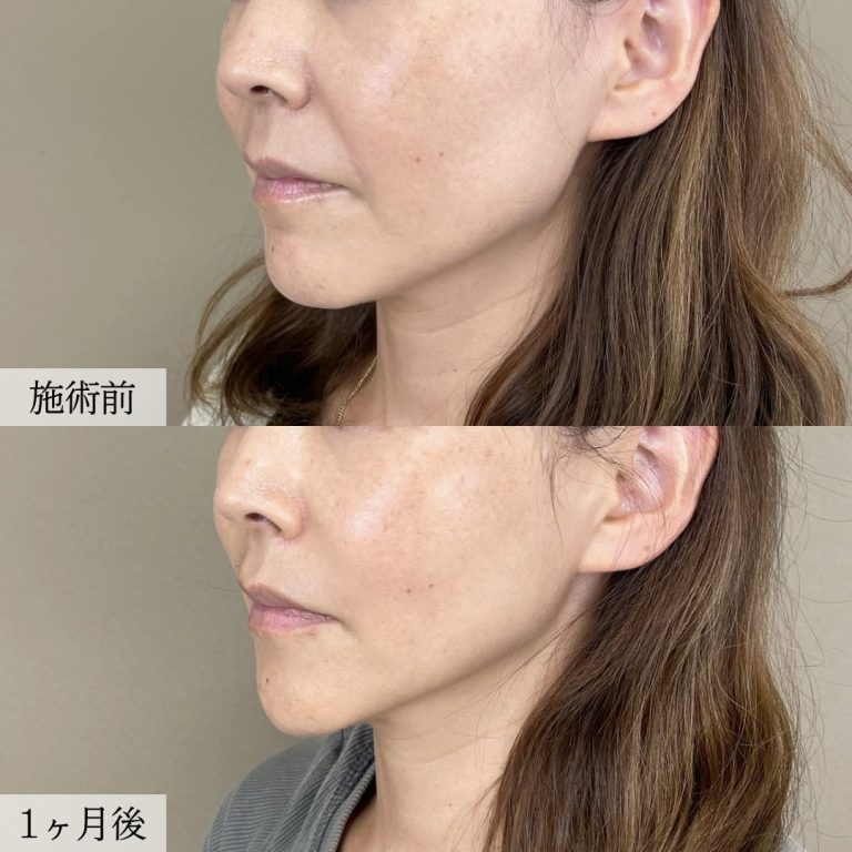 小顔美肌再生（リフトアップ）(担当医:大見 貴秀 医師)の症例写真2