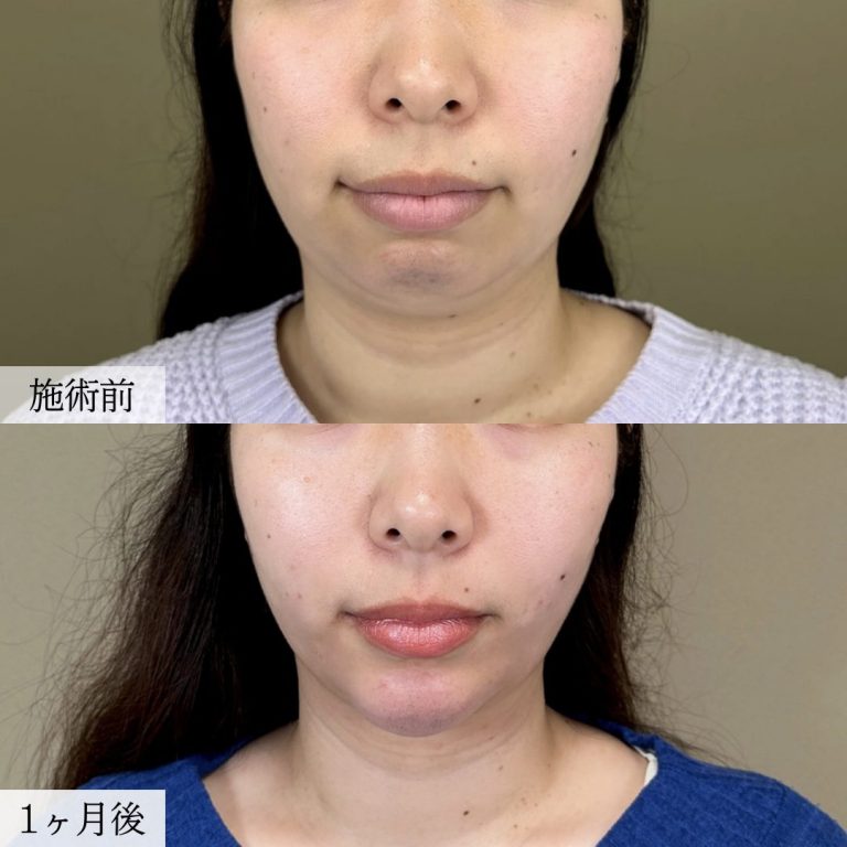 顔の脂肪吸引(担当医:大見 貴秀 医師)の症例写真1