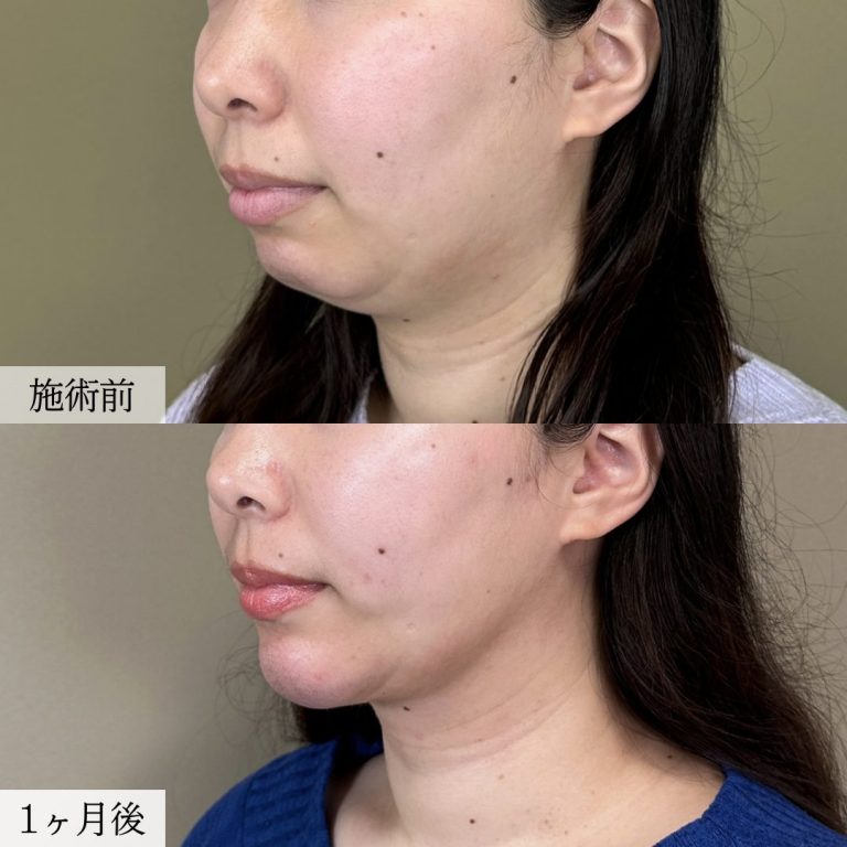 顔の脂肪吸引(担当医:大見 貴秀 医師)の症例写真2