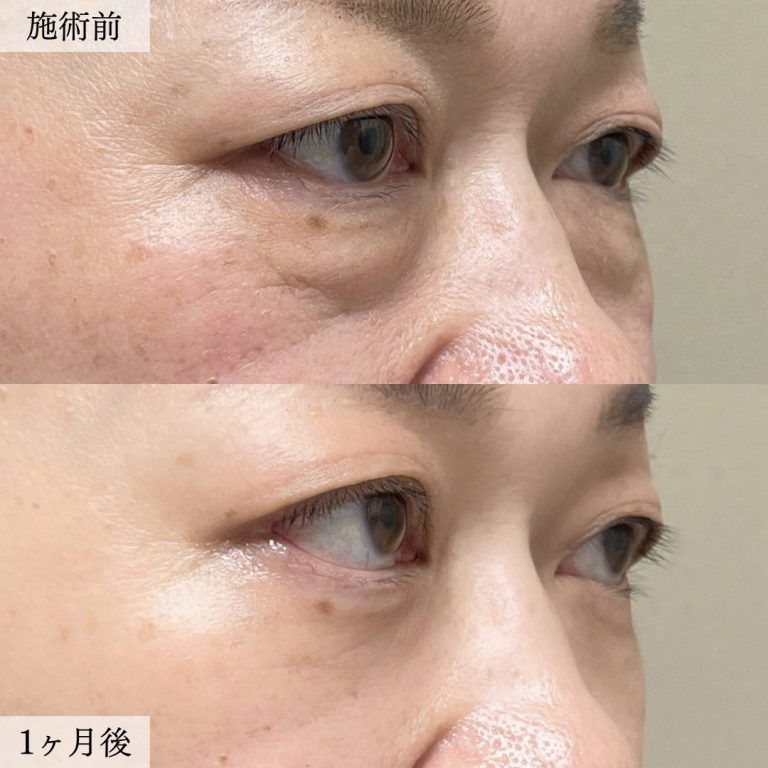 切らない目の下のクマ取り・目の下のたるみ（ふくらみ）取り(担当医:大見 貴秀 医師)の症例写真2