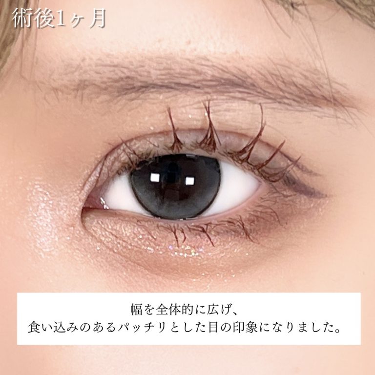 二重埋没法(担当医:川島 康弘 医師)の症例写真3