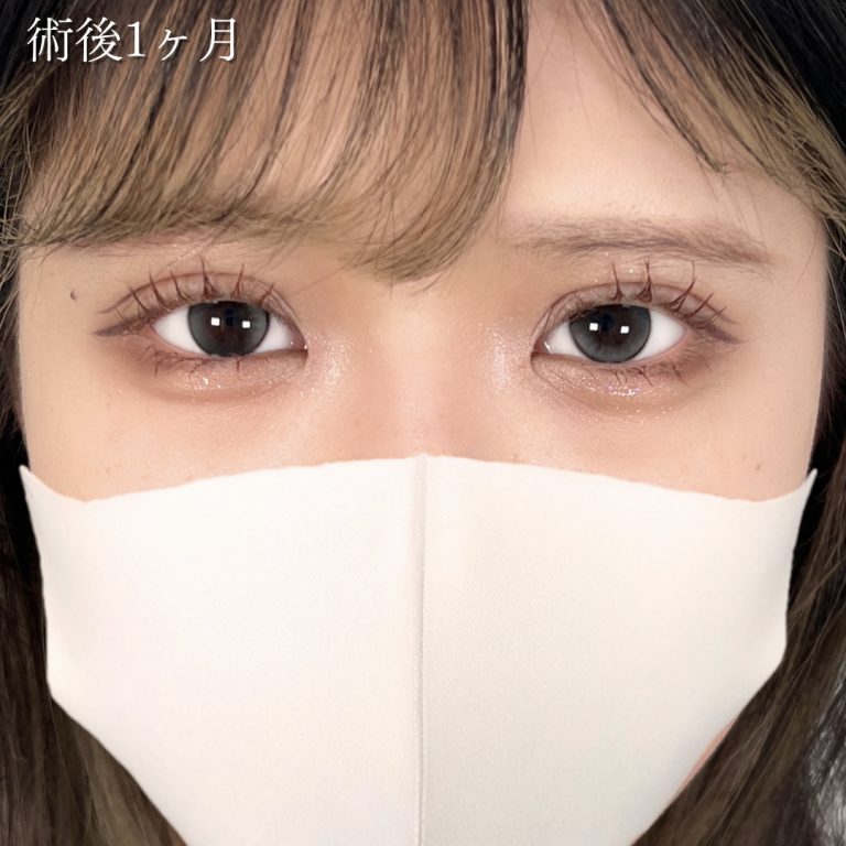 二重埋没法(担当医:川島 康弘 医師)の症例写真1